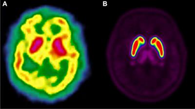 Innovative Molecular Imaging for Clinical Research, Therapeutic Stratification, and Nosography in Neuroscience